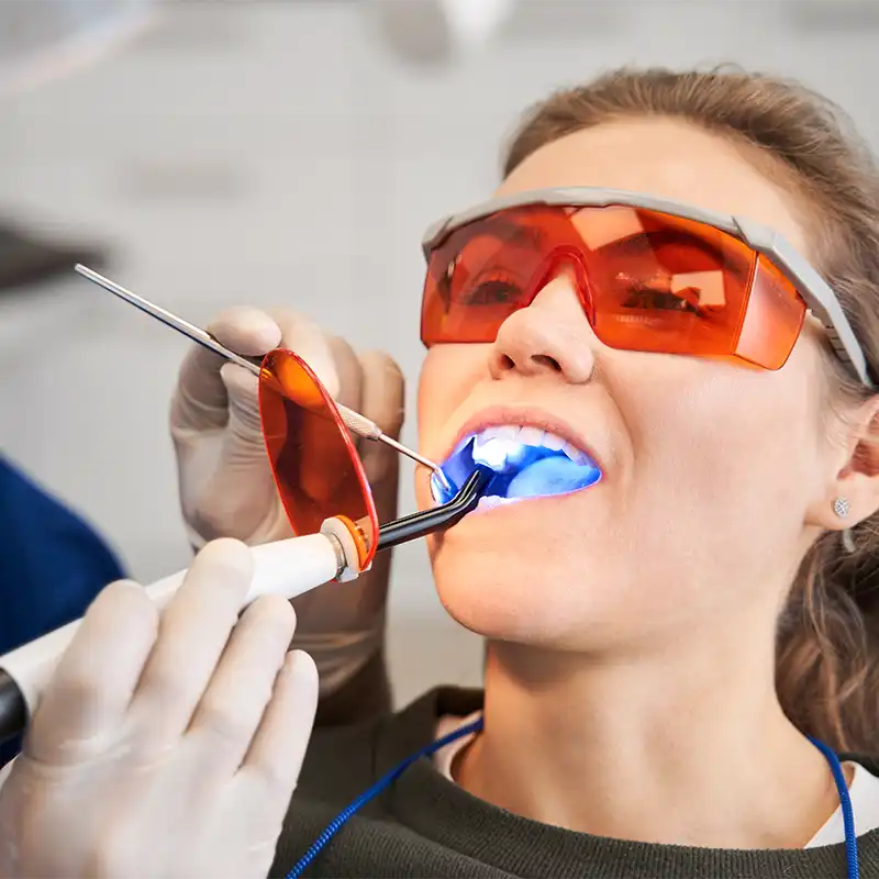 Sbiancamento dentale a Mantova