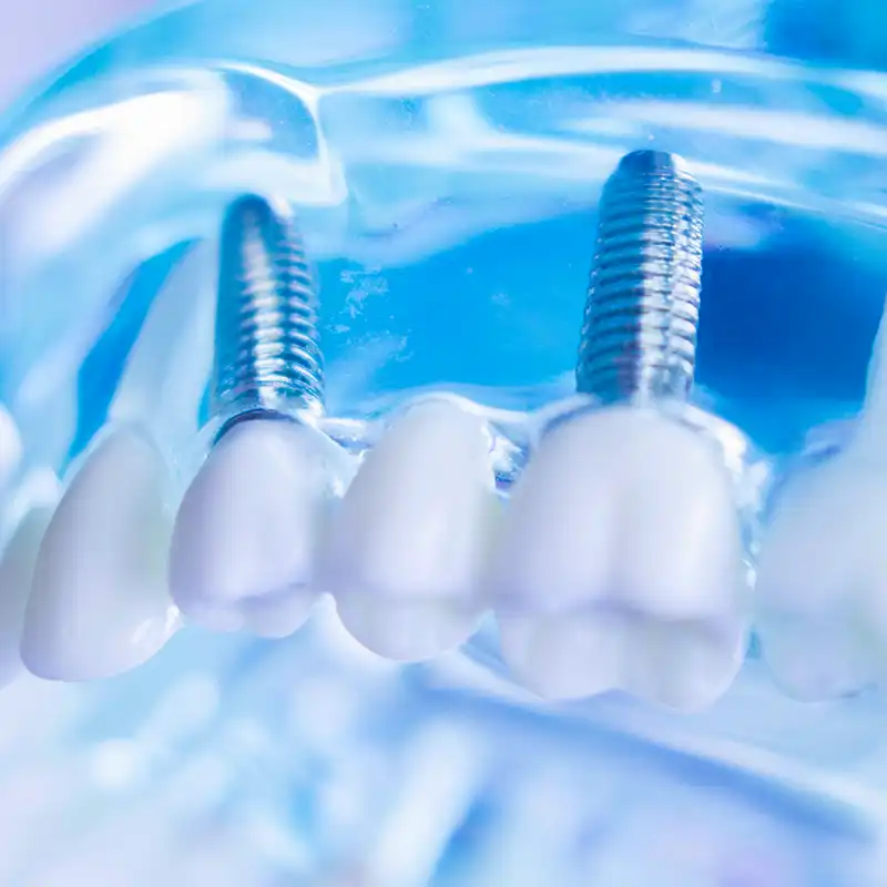 implantologia zigomatica