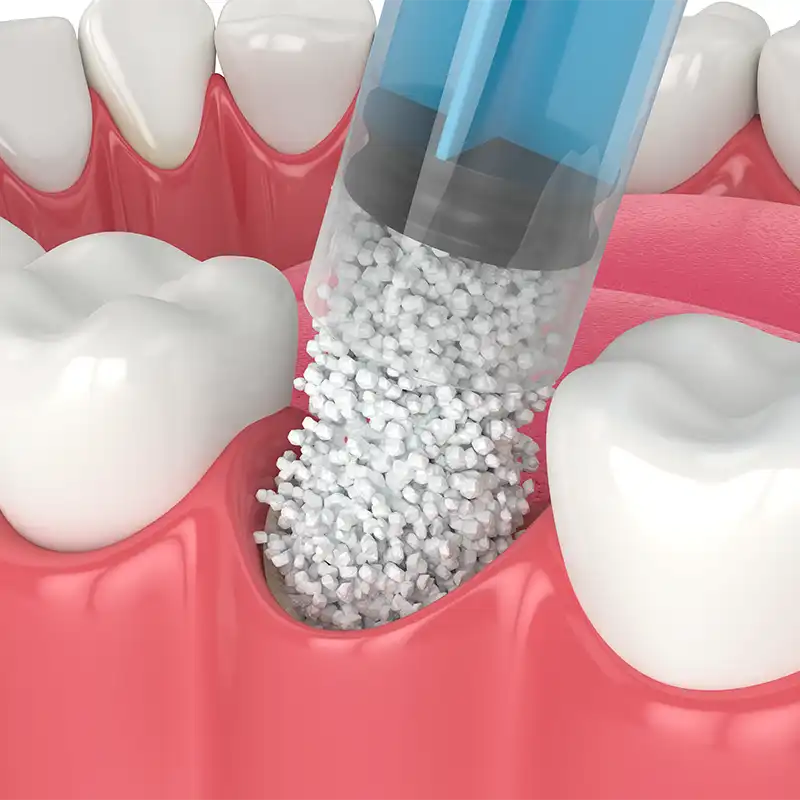 ricostruzione ossea dentale