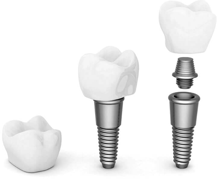 che cos'è un impianto dentale