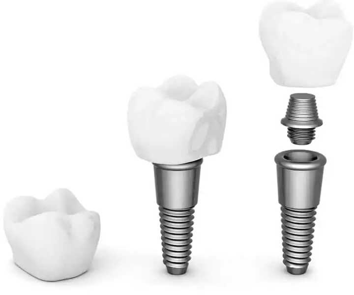 che cos'è un impianto dentale