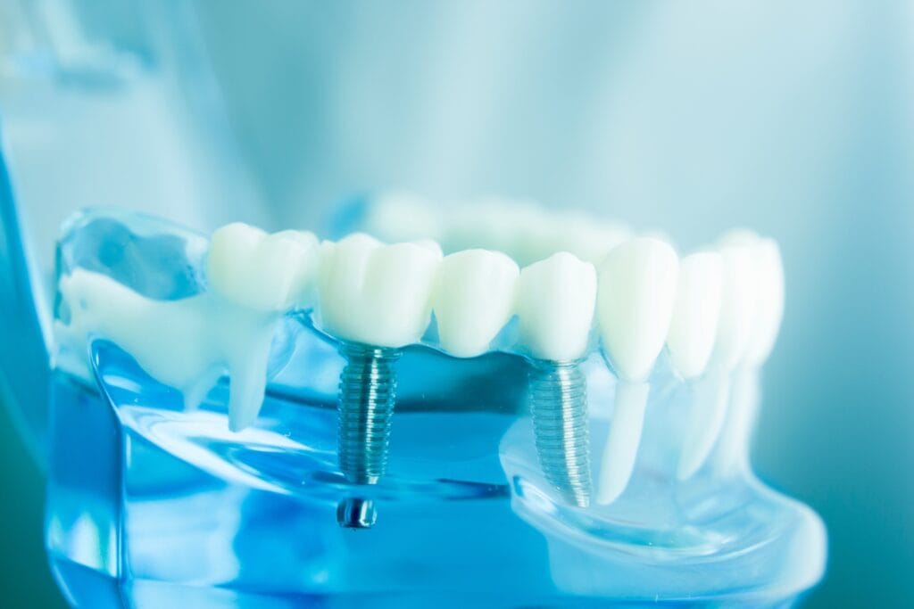 Come pulire impianto dentale
