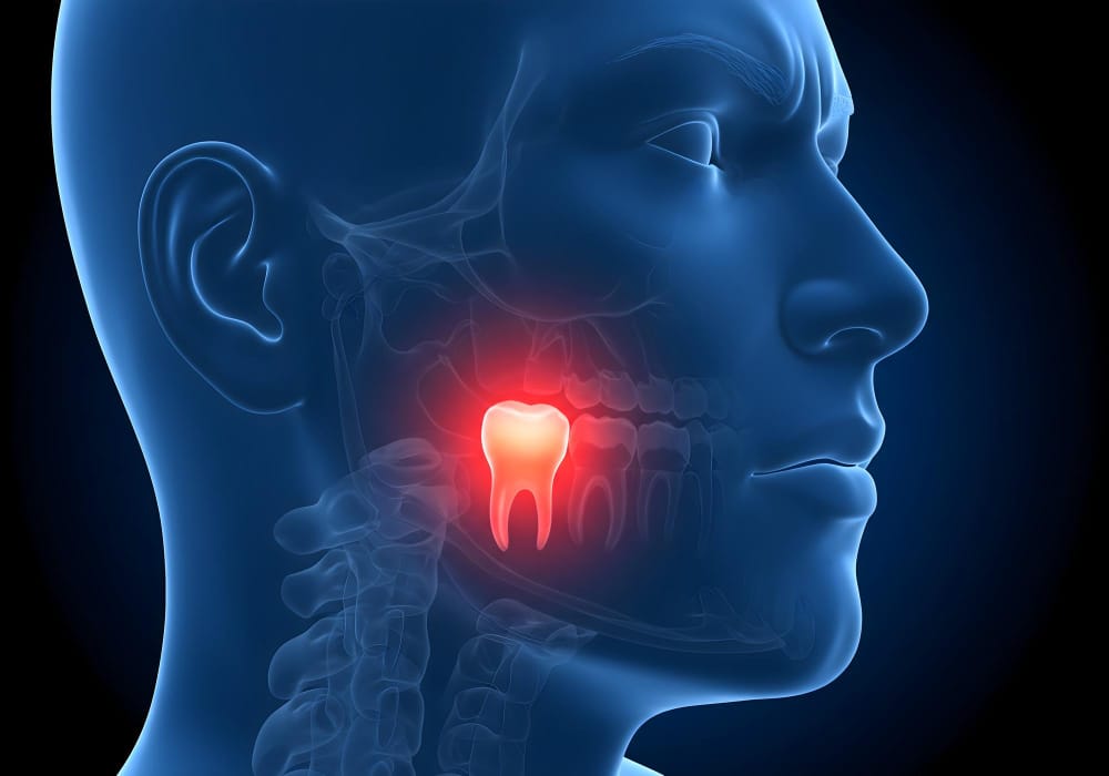 come capire se il dente del giudizio è da togliere